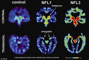 फुटबॉल खिलाड़ियों का दिमाग(Football players’ brains)